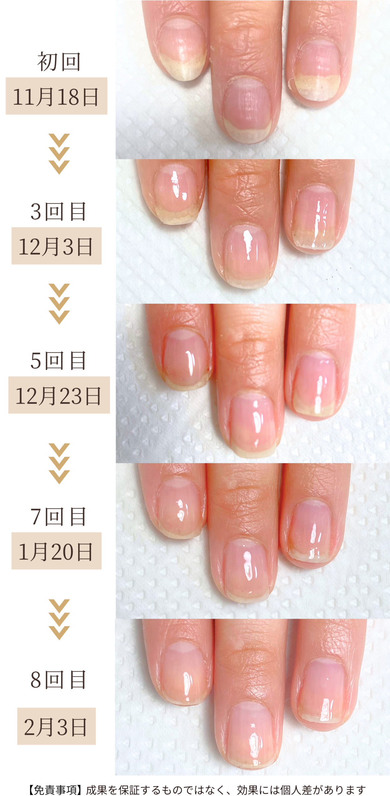 自爪育成ケア 3ヶ月コースの育成症例