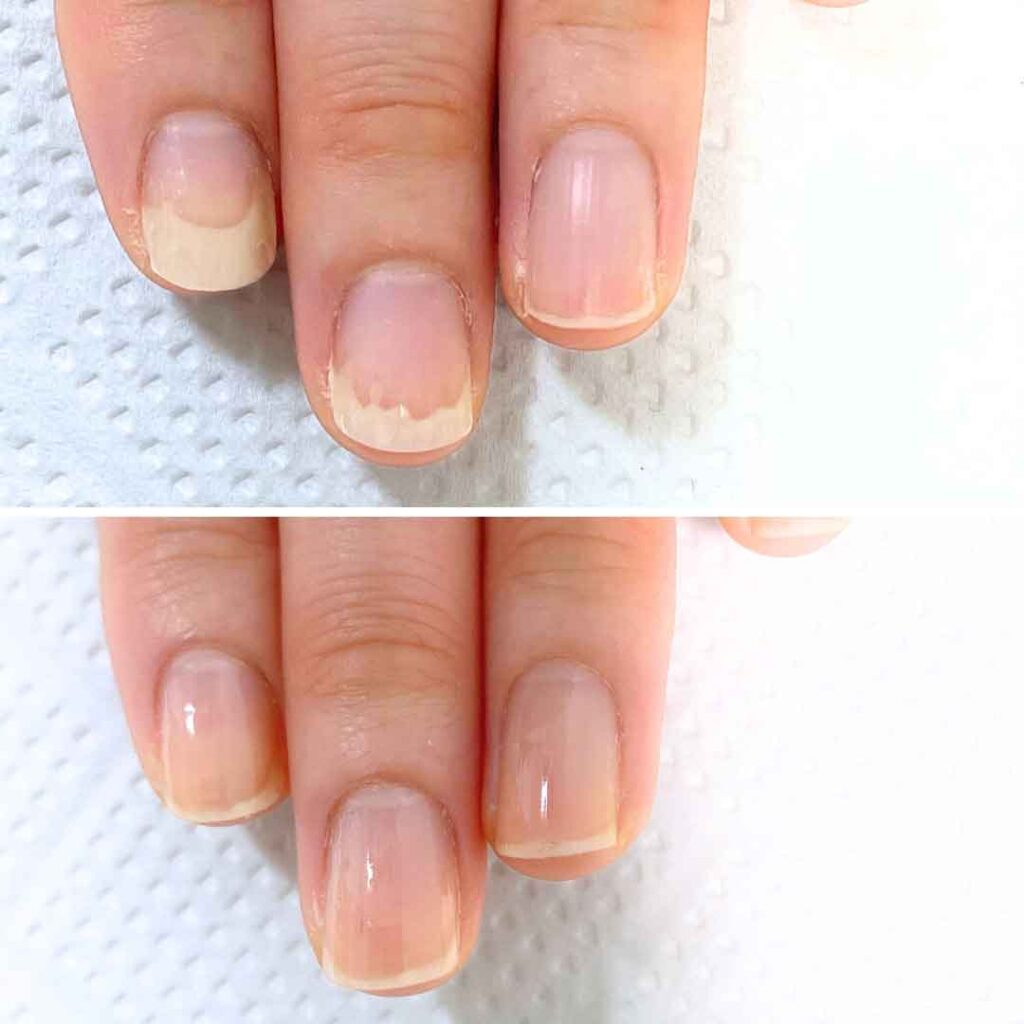 K様 女性/30代/介護職
お悩み：爪甲剥離の症例写真2