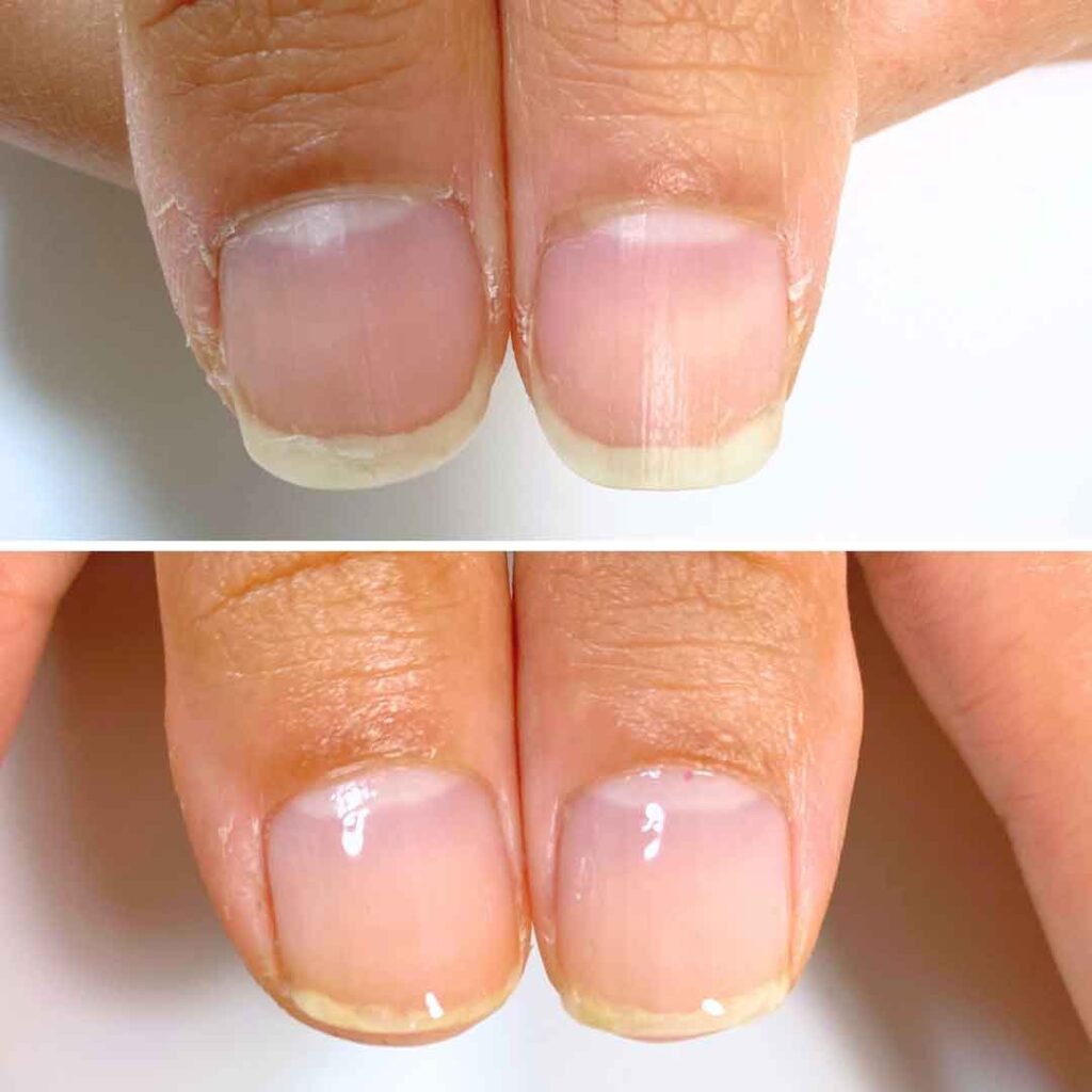 お悩み：欠ける爪 2枚爪の症例写真1