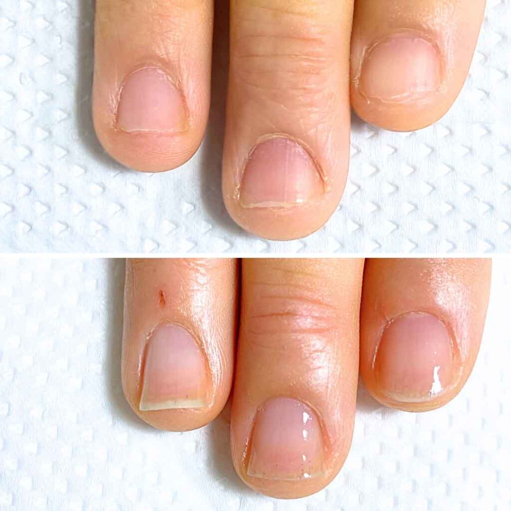 Y様 女性/20代/薬剤師
お悩み：深爪 乾燥の症例写真3