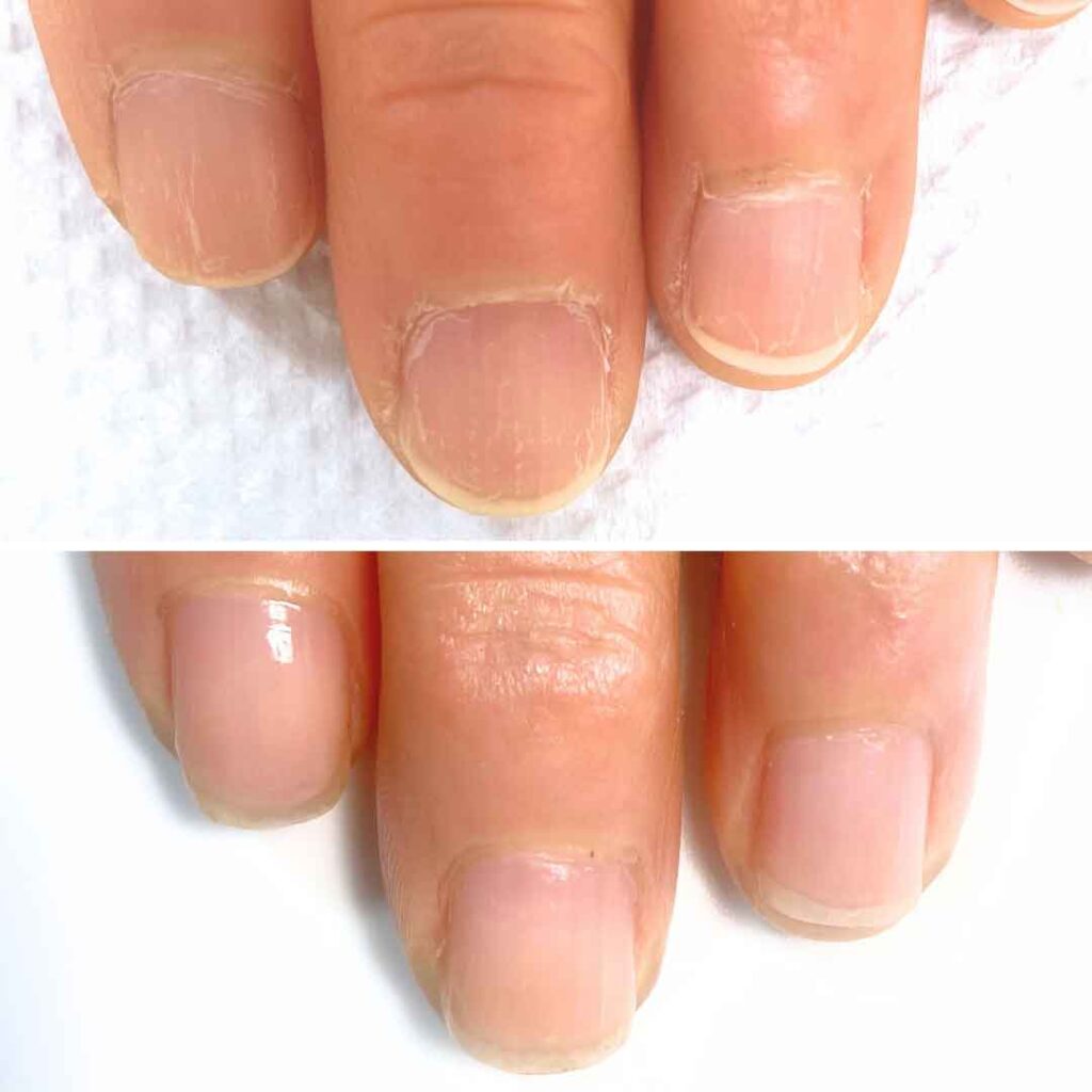 お悩み：薄い 乾燥 甘皮の症例写真2