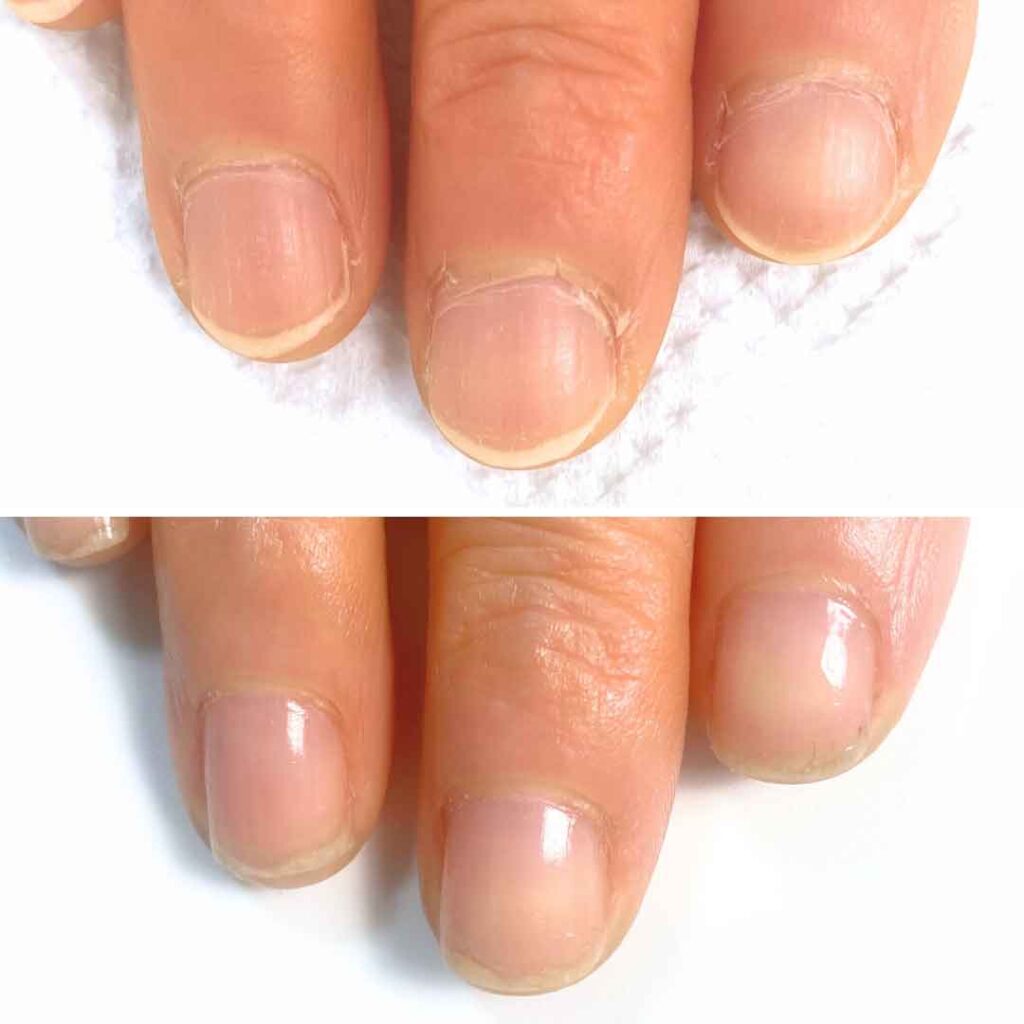 お悩み：薄い 乾燥 甘皮症例写真3