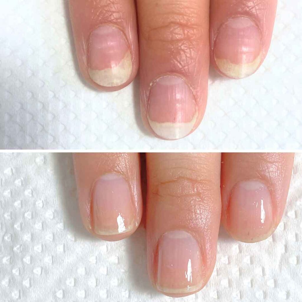 お悩み：爪甲剥離の症例写真3