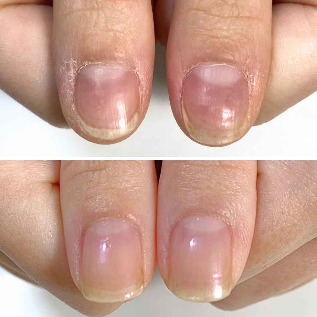 お悩み：薄い爪 乾燥 噛み癖の症例写真1