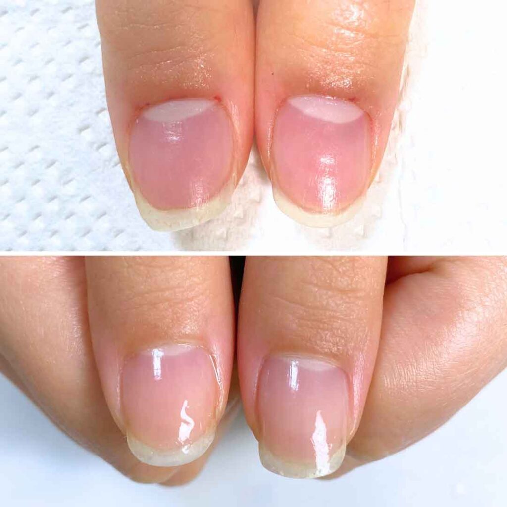 お悩み：小さい爪 乾燥 いじり癖の症例写真1