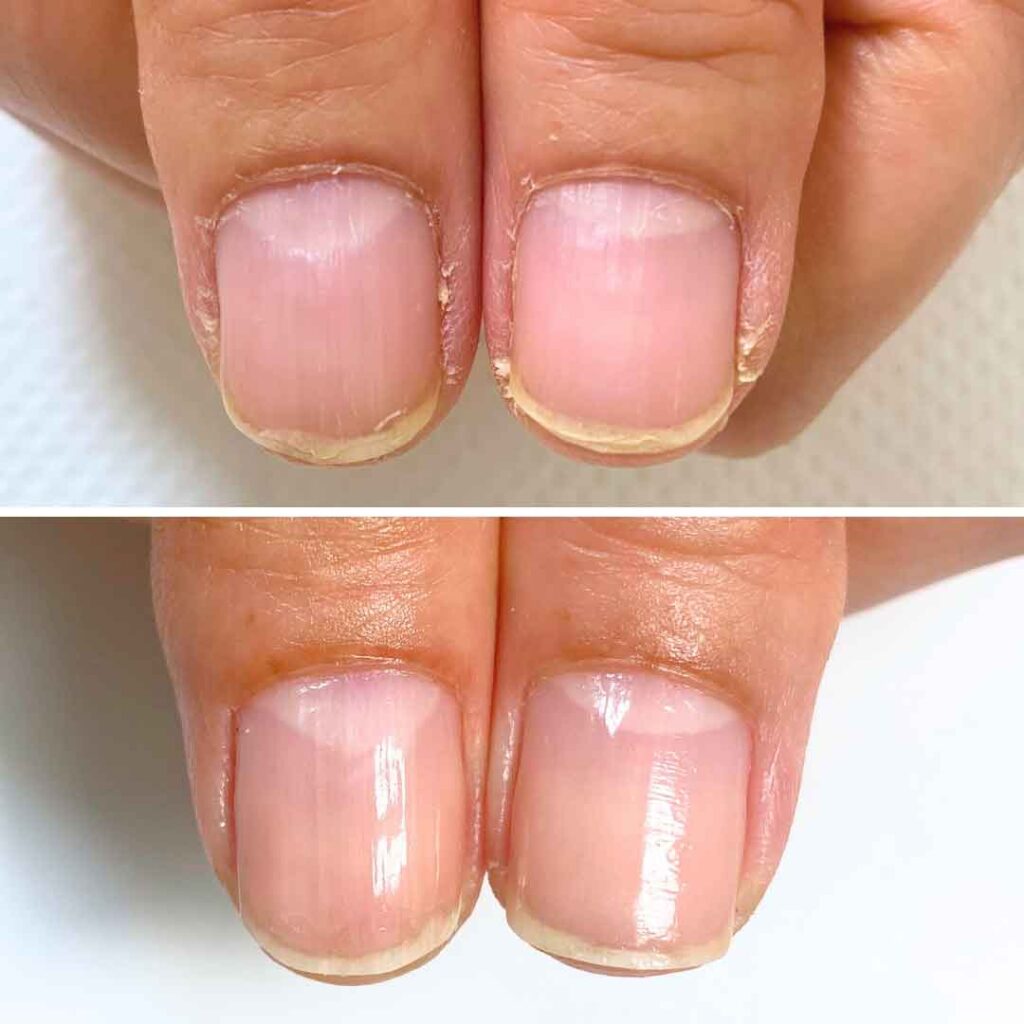 お悩み：縦筋 乾燥の症例写真1