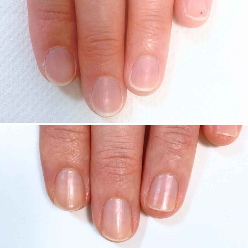 お悩み：乾燥 2枚爪 反り爪の症例写真3