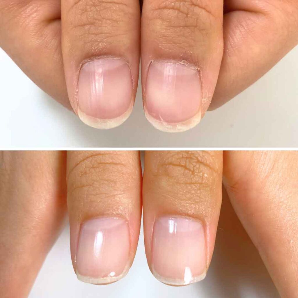 お悩み：薄い爪 縦筋 2枚爪の症例写真1
