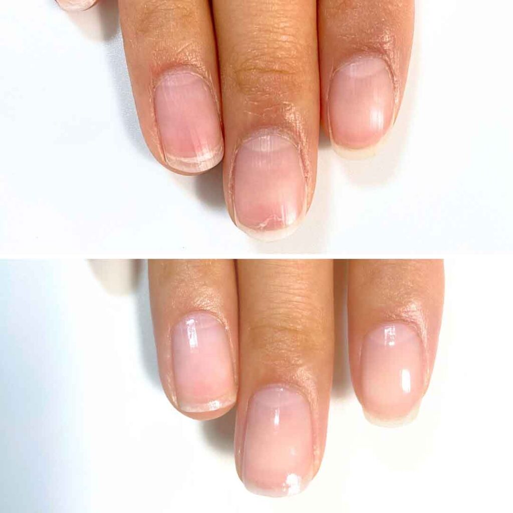 お悩み：薄い爪 縦筋 2枚爪の症例写真3