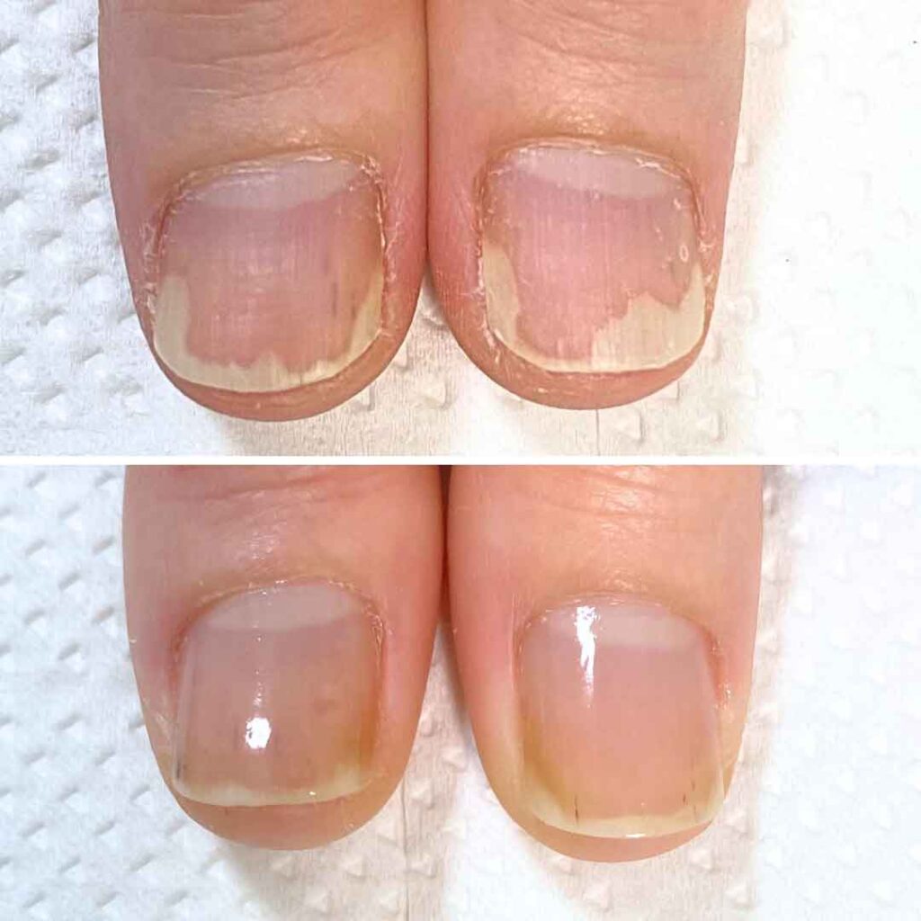 K様 女性/30代/介護職
お悩み:爪甲剥離
初回→8回目(約3ヶ月)の爪の育成写真