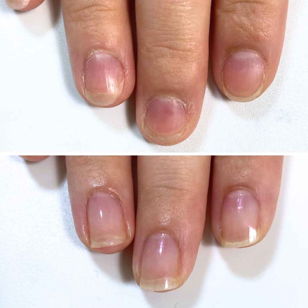 K様 女性/30代/介護職
お悩み:爪甲剥離
初回→8回目(約3ヶ月)の症例写真