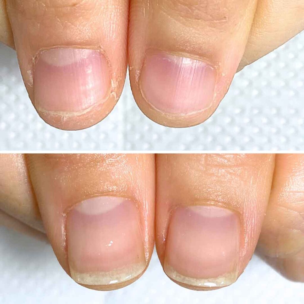 Y様 女性/20代/薬剤師
お悩み:深爪 乾燥
初回→8回目(約3ヶ月)の症例写真