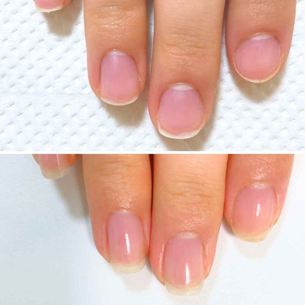 K様 女性/30代/介護職
お悩み:爪甲剥離
初回→8回目(約3ヶ月)症例写真