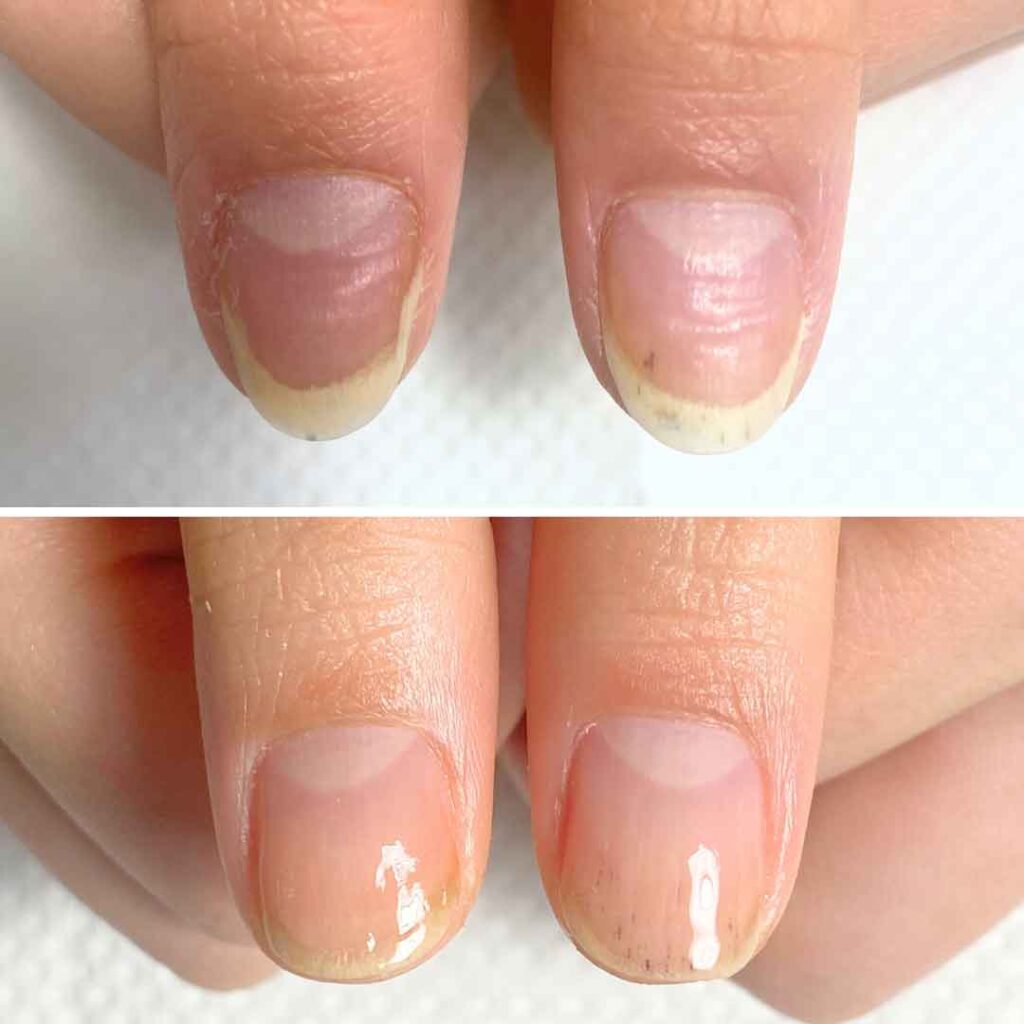 E様 女性/10代/大学生
お悩み:爪甲剥離
初回→8回目(約3ヶ月)ぼ症例写真