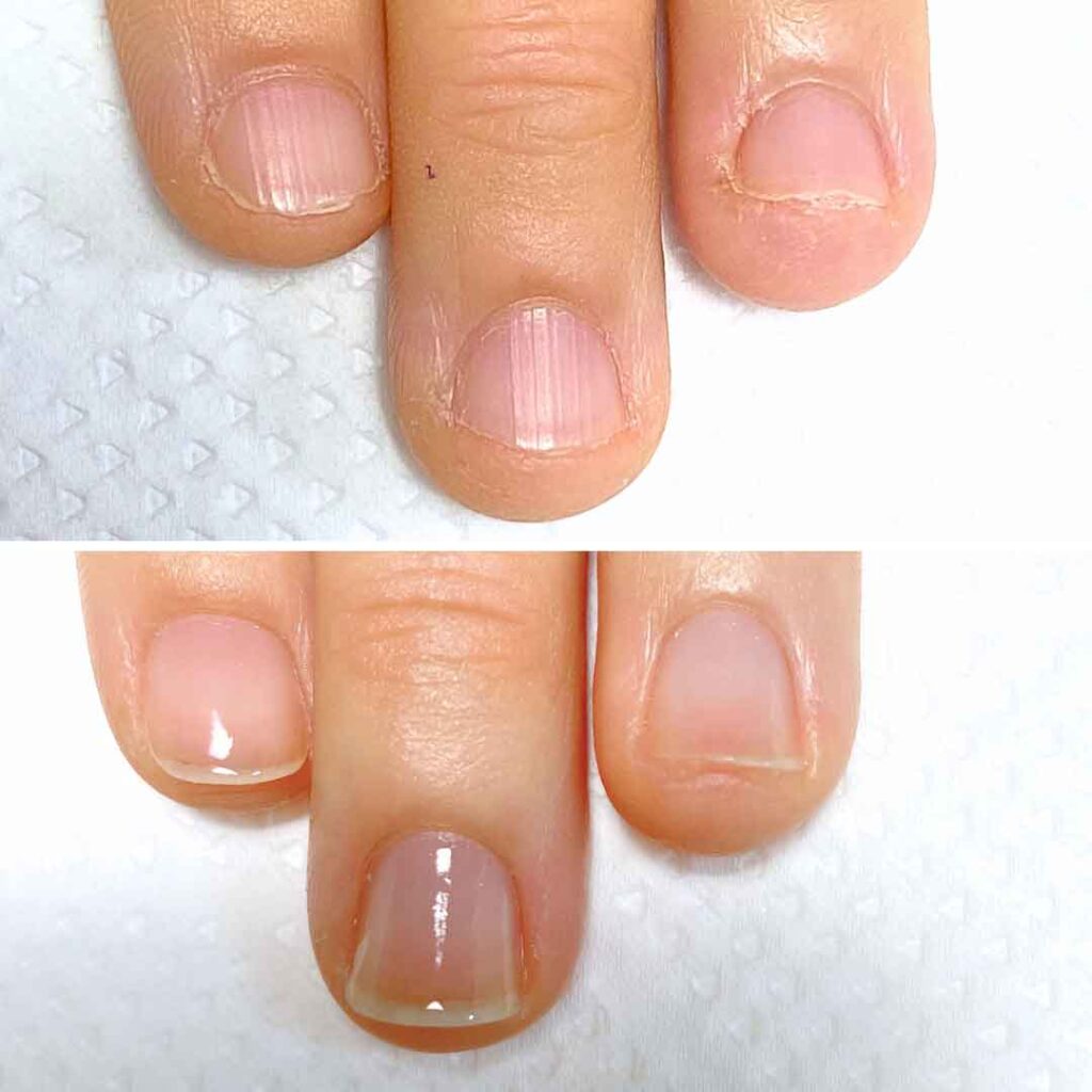 Y様 女性/20代/薬剤師
お悩み:深爪 乾燥
初回→8回目(約3ヶ月)の症例写真